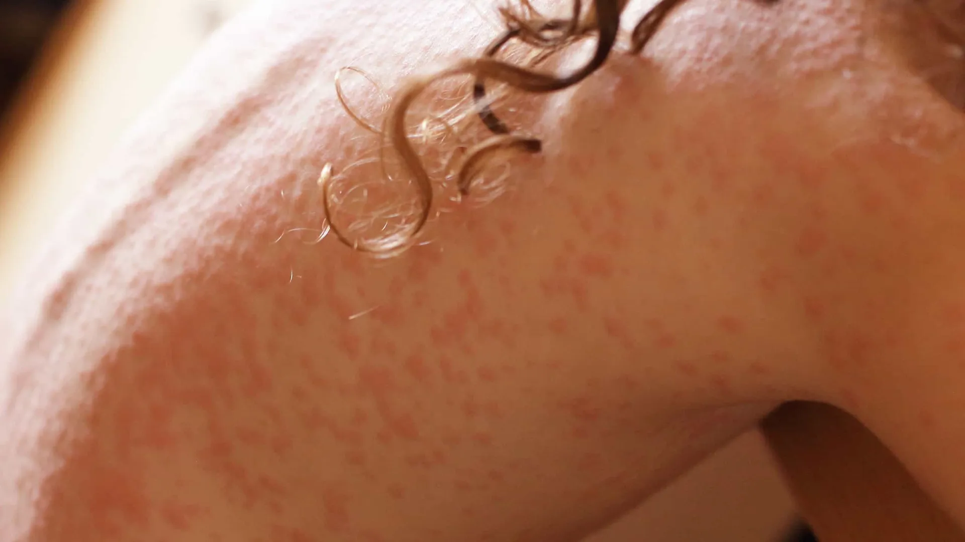 Brasil registra primeiro caso de infecção por fungo altamente transmissível